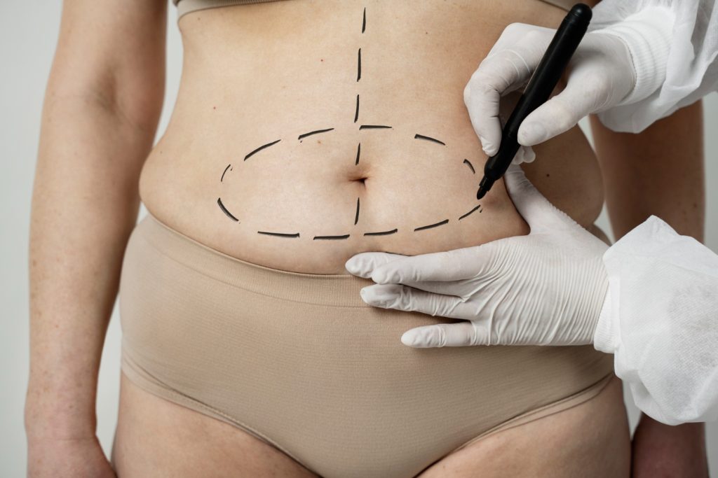 Liposuction