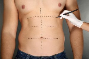 Liposuction for men